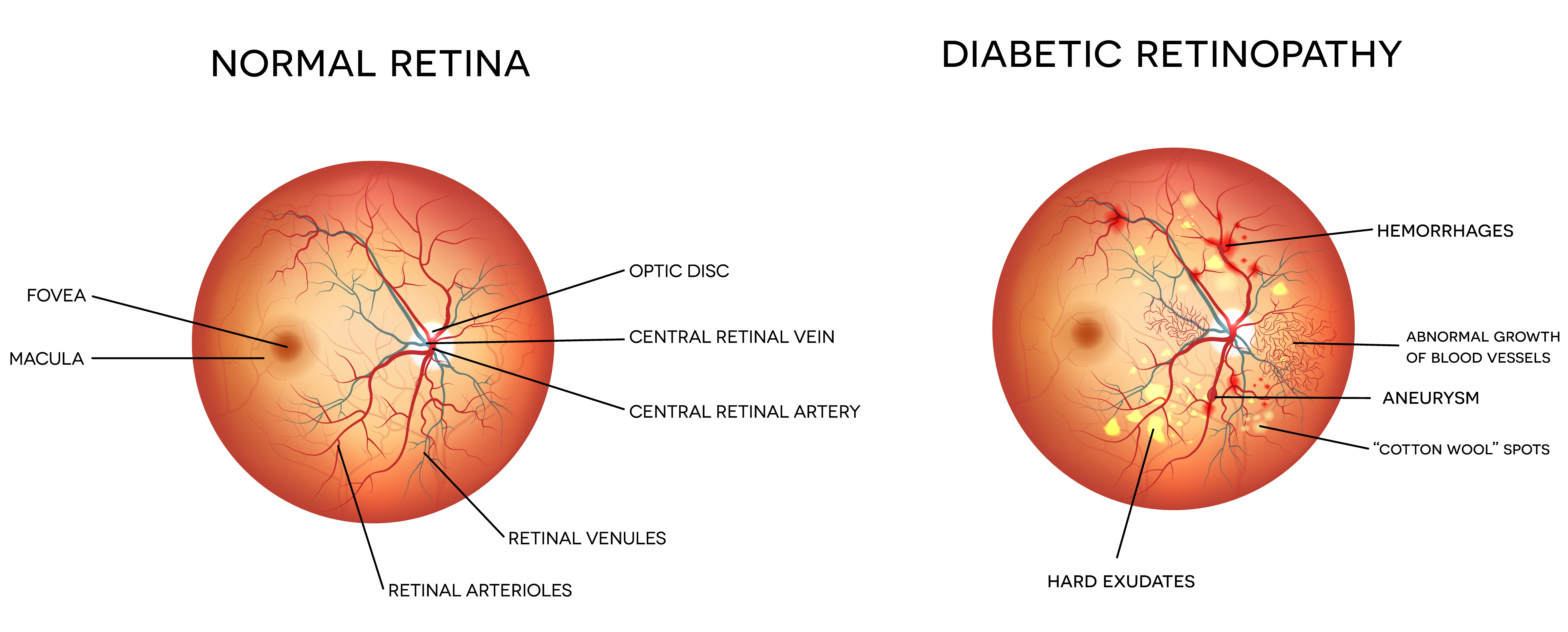 diabetic-retinopathy-south-east-eye