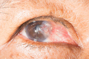 Pterygium Symptoms and Treatment | South East Eye